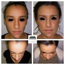 Lipofilling, volumes du visage, Lyon