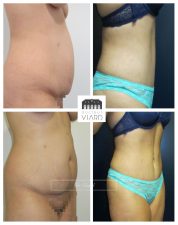 Abdominoplastie avec liposuccion d'un ventre, Lyon