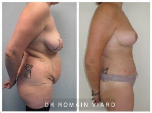 Avant apres Abdominoplastie, lipoaspiration + mastopexie mammaire