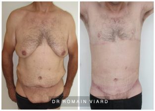 Bodylift chez un homme Avant Apres