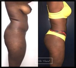 Lipofilling des fesses et liposuccion des contours