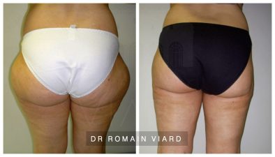 Avant et Après, Lipoaspiration de la culotte de cheval, Chirurgie esthétique, Lyon