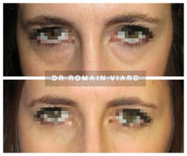 Blepharoplastie chez une jeune femme a Lyon