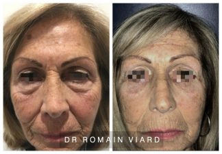 Blepharoplastie, chirurgie des paupieres, Dr Romain Viard