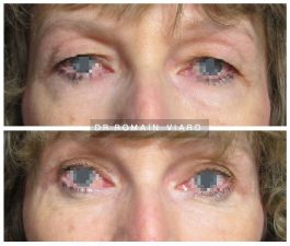 Blépharoplastie supérieure et inférieure, Chirurgie plastique, Lyon