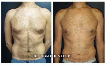 Gynecomastie et Abdominoplastie, Lyon, Avant Apres