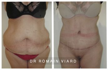 Abdominoplastie, chirurgie bariatrique, Lyon