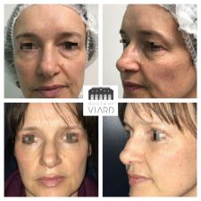 Blepharoplastie, chirurgie des paupieres a Lyon