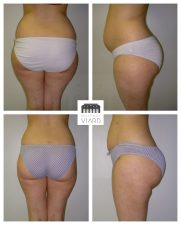 Résultat avant après, Lipoaspiration des cuisses, Chirurgie Plastique, Lyon