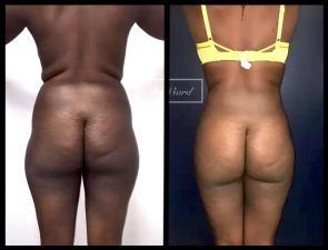 Liposuccion des fesses a Lyon