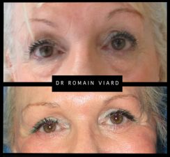 Blepharoplastie inferieure, regard fatigue