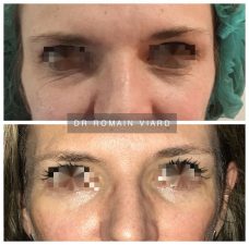 Avant apres Blepharoplastie inferieure Lyon, chirurgie du visage