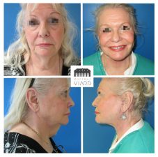 Lifting cervico facial, blépharoplastie, lipostructure facial