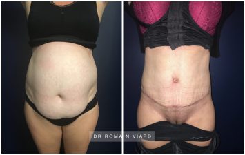 Plastie abdominale, Lyon, Dr Romain Viard