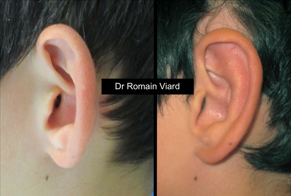 Correction des oreilles décollées à Genève - Dr Prevot, chirurgie