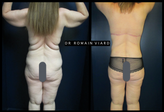 brachioplastie couplee d'un bodylift superieur, Lyon