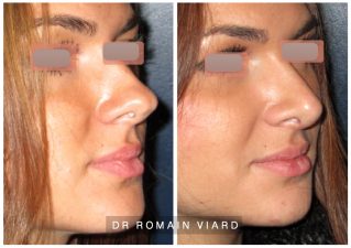 Rhinoplastie de pointe, Chirurgie plastique, Lyon