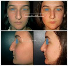 Rhinoplastie, avant apres, Lyon