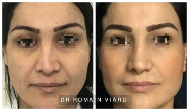 Rhinoplastie operation du nez Dr Romain Viard