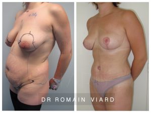 mastopexie, abdominoplastie, lipoaspiration combinaison