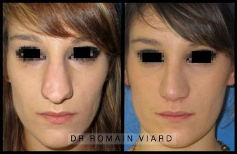 Résultat à 1 an d’une rhinoplastie pour un nez hyperprojetté.