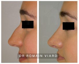 Rhinoplastie, photo avant et apres, chirurgie plastique à Lyon