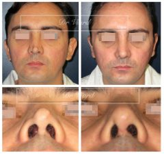 La chirurgie secondaire du nez : rhinoplastie secondaire, correction à Lyon