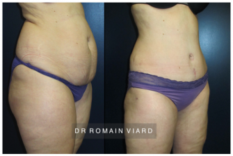 Lipoaspiration des hanches et Abdominoplastie, Dr Viard