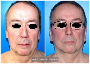 Lifting facial chez un homme, Chirurgie du visage, Lyon