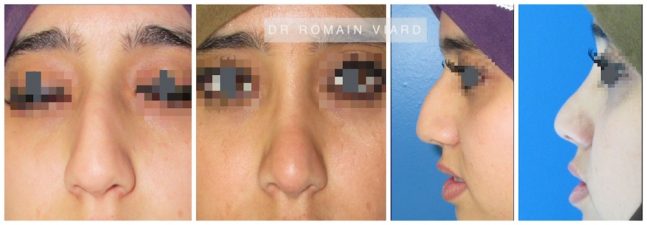 Rhinoplastie, operation du nez, Avant apres, Lyon