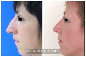 Resultat Rhinoplastie et genioplastie a Lyon