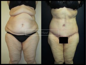 sequelles d'amaigrissement, abdominoplastie, liposuccion