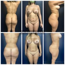 Lipofilling des fesses, Dr Viard, Lyon